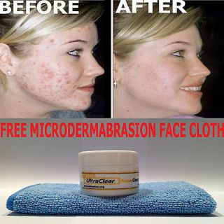   Acne Blackhead Spot Scar Treatment Cream & FREE Microfibre Face Cloth