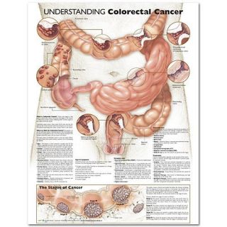 Understand Colorectal Colon Cancer Anatomical Chart Anatomy Poster