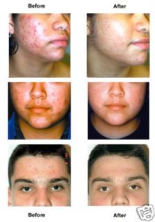 Face Body Acne Spots Cure Rosacea Scars Repair Cream